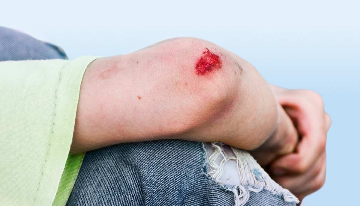 Schürfwunden | Wunden